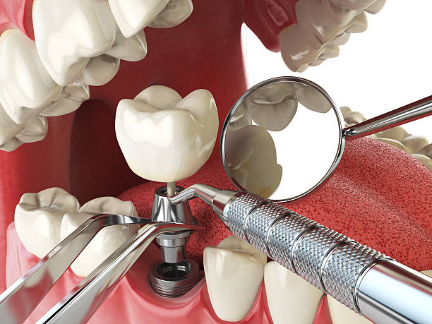 Best Emergency Dental Care for Broken or Chipped Teeth in Jonesville, VA